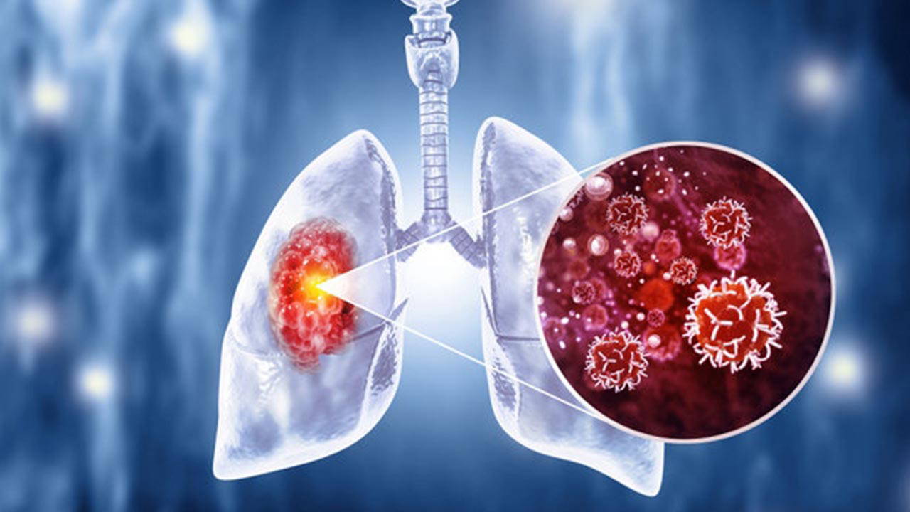 Uzmanı uyardı: 'Akciğer kanserinde beslenme bağışıklığı etkiliyor'