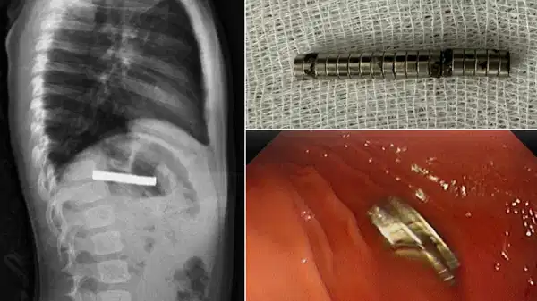 Elazığ'da doktorları şaşırtan olay: Çocuğun yemek borusundan 19 mıknatıs çıkarıldı!