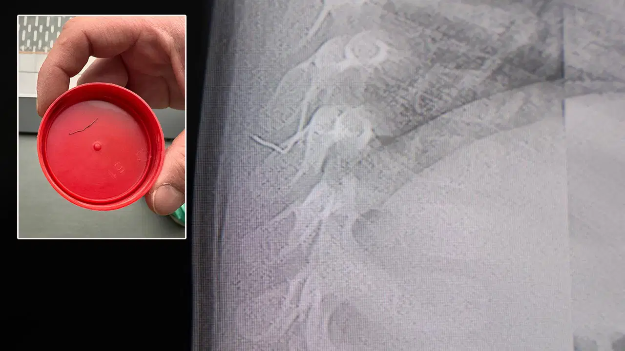 '8 yaşına kadar bekleyin' dediler: Bebeğin akciğerinden çıkan cisim şaşırttı!