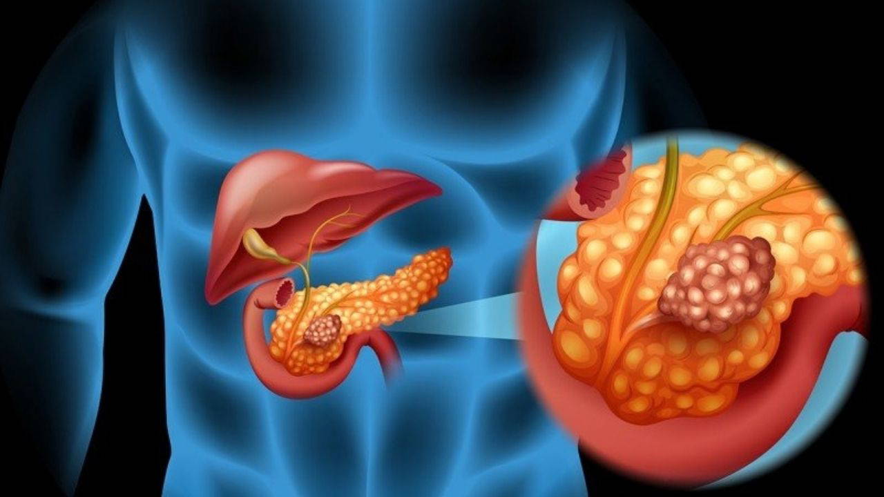 Uzmanı pankreas kanserine karşı uyardı: 'Artan sigara kullanımı riski yükseltiyor'