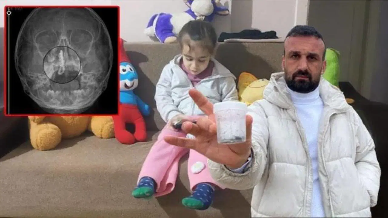 5 yaşındaki Polen'in burnundan tırnak makası zinciri çıktı!