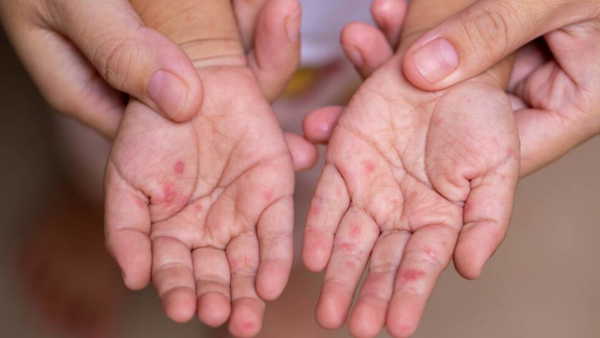 Kızamık ve boğmaca vakaları yeniden gündemde: 'Aşısızlık oranı yüzde 10’un üzerine çıktı'