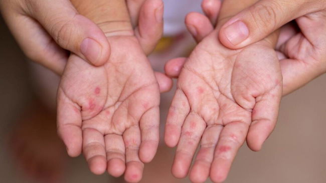 Kızamık ve boğmaca vakaları gündemde