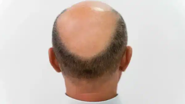 3 haftada saç çıkaran 'mucize serum' geliştirildi