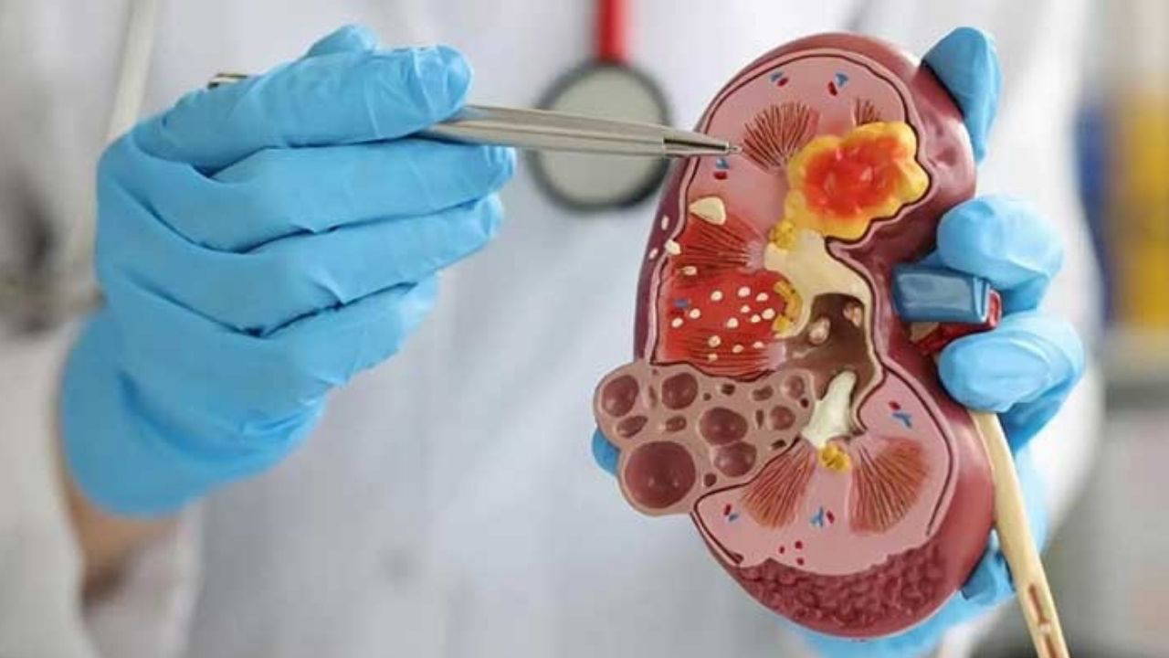 Uzmandan uyarı: Çocuklarda böbrek taşı riski artıyor