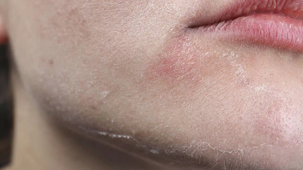 Kışın kuruyan cildi sadece soğuğa yormayın