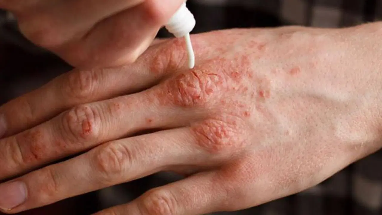 Ciltte kaşıntı ve kızarıklığa dikkat: Egzama belirtileri neler?