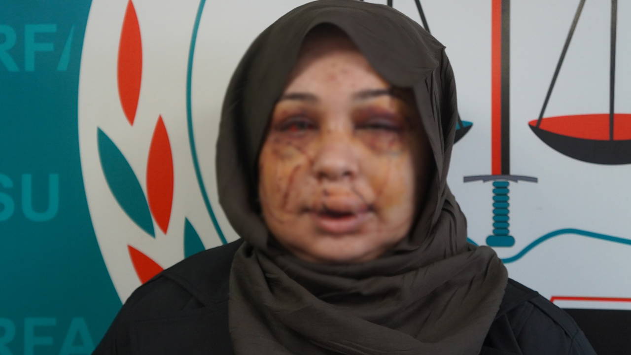 Polis eşi tarafından darbedildiği iddiasıyla şikayetçi oldu: 'Vicdanı olan herkesten yardım istiyorum'