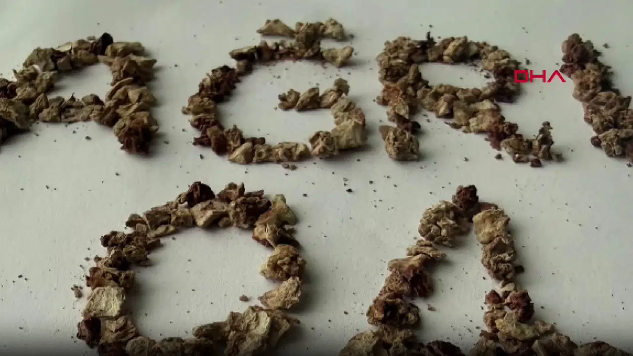 21 kez operasyon geçiren hastadan 295 böbrek taşı çıkarıldı