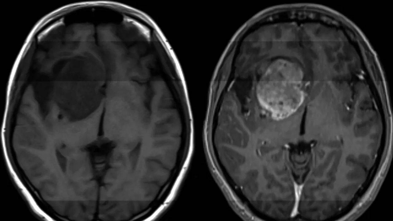 Beyin kanserinde yıllardır süren çıkmazda kritik gelişme: Sağlıklı dokuya zarar vermeden yok ediyor