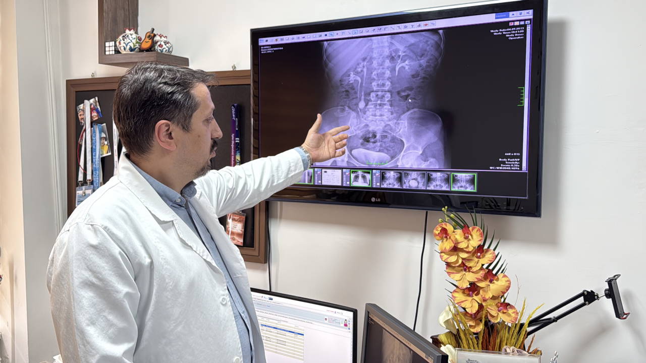 Doktorlar bile şaşırdı: İdrar kanalından 51 taş çıkarıldı!