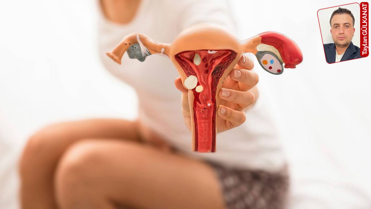 Çikolata kistine karşı kritik uyarı: 'Her 10 kadından 1’ini etkiliyor'