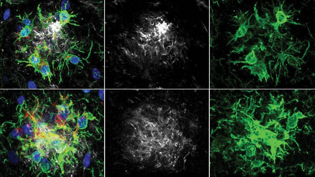 Alzheimer tedavisinde yeni ufuk: Beynin 'temizlik ekibi' yeniden programlandı