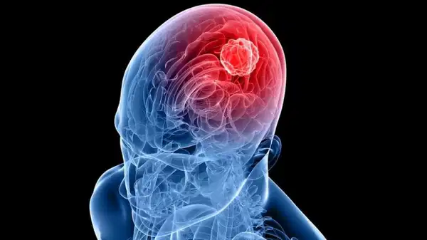 Bilim insanlarından umut veren yöntem: Burun spreyiyle ölümcül beyin tümörü tedavisi