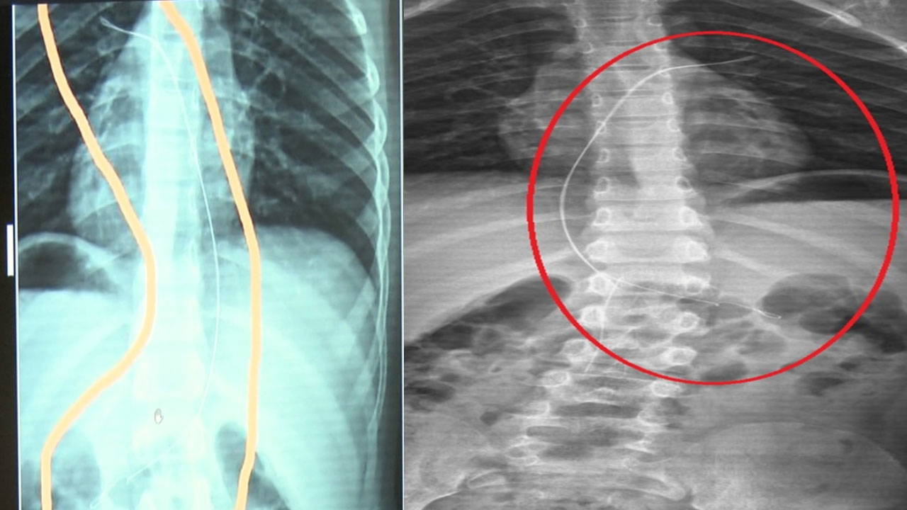 6 yaşındaki çocuğun içinde kateter unutuldu!