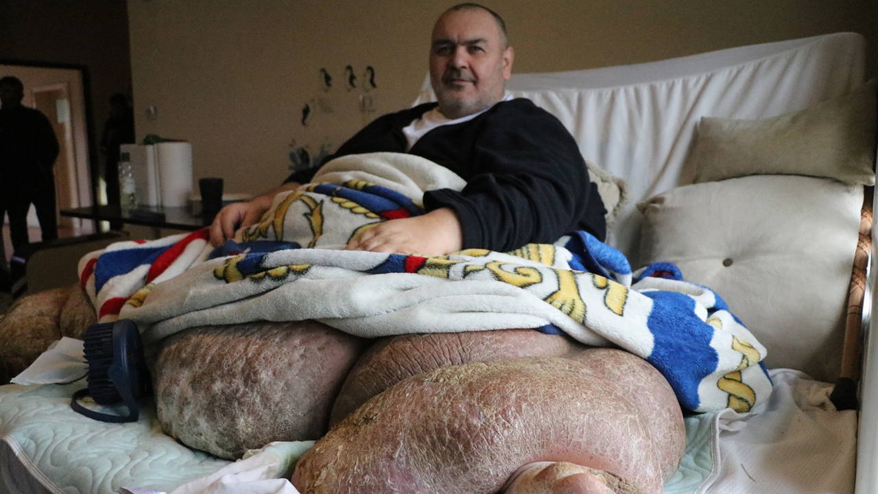 300 kiloya ulaşan fil hastası 30 kişi tarafından evinden çıkarıldı!