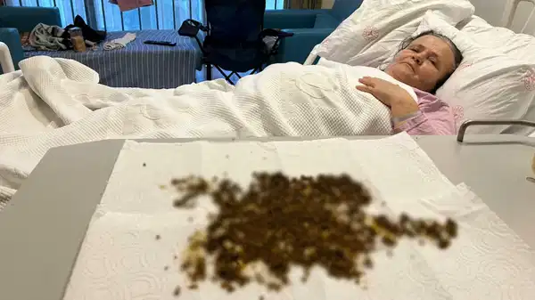 Manisa'da 'yapay zeka'lı nadir ameliyat: Safra kesesinden 20 binden fazla taş çıkarıldı!