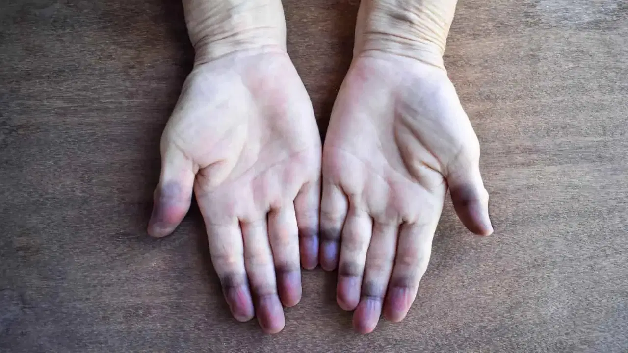 Uzmanı uyardı: 'El ve ayaklarda ani mavi-mor renk değişimlerine dikkat'