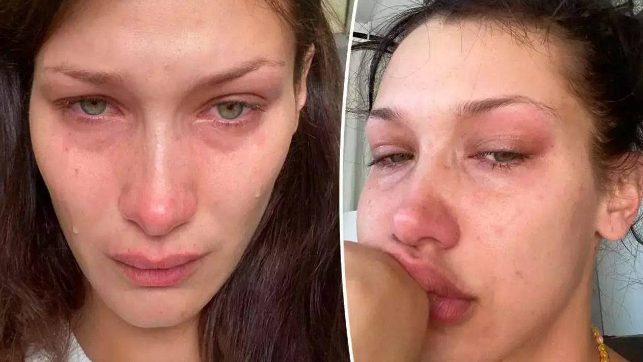 Lyme Hastalığı nedir? Lyme hastalığı belirtileri neler? Lyme hastalığı nasıl tedavi edilir?