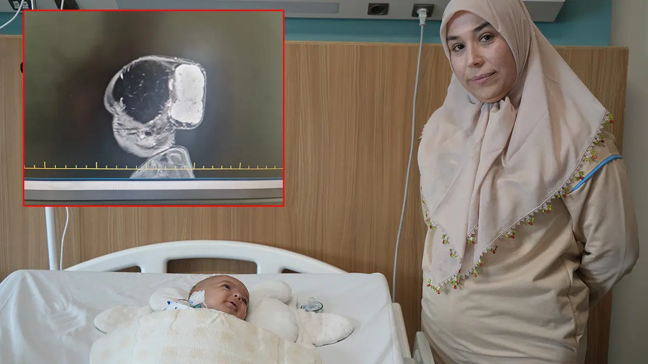 Dünyada nadir görülüyor! Minik Talha’nın kafasındaki 'dev' kitle 4 saatte çıkarıldı