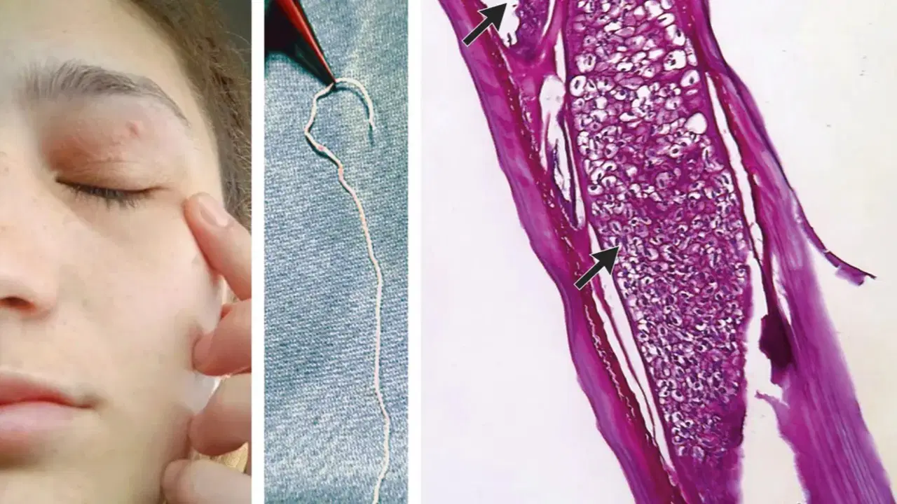 Bir ay yüzünde dolaştı, göz kapağından çıktı