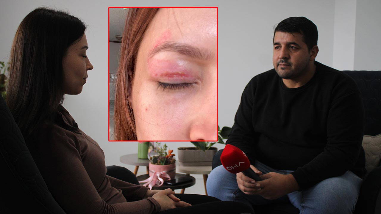 Güzellik salonunda yaptırdığı işlem kabusu oldu! Göz kapağı yandı, doktorlar ameliyata korkuyor