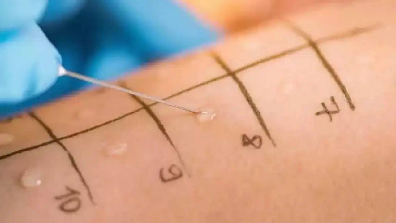 Alerji testlerine erişimde eşitsizlik