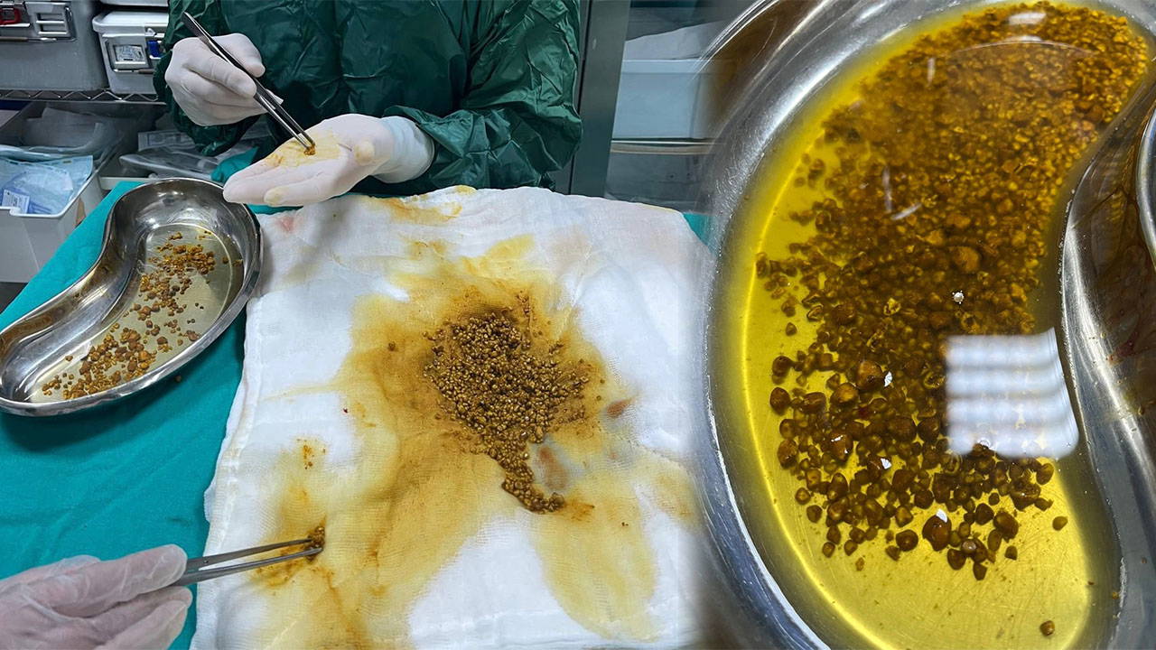 Tıp dünyasını şaşırtan ameliyat: Safra kesesinden 2 bin 67 taş çıktı!