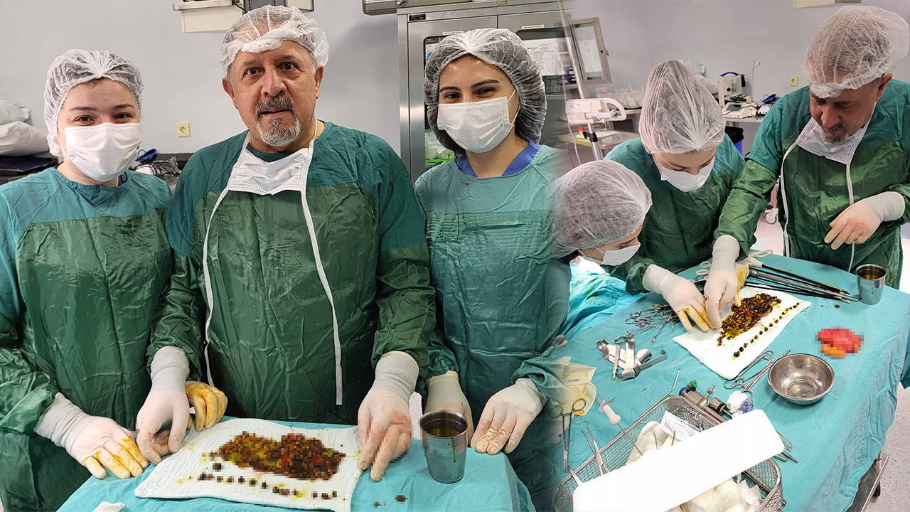 Karın ağrısıyla gitti, safrasından binlerce taş çıktı