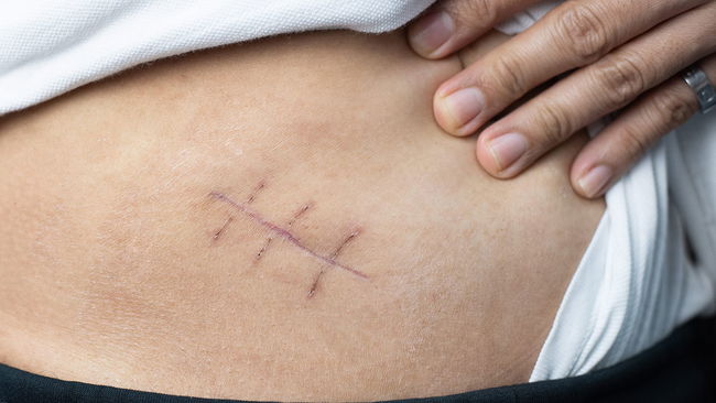 Kadın hastalıklarında 'izsiz' ameliyat dönemi