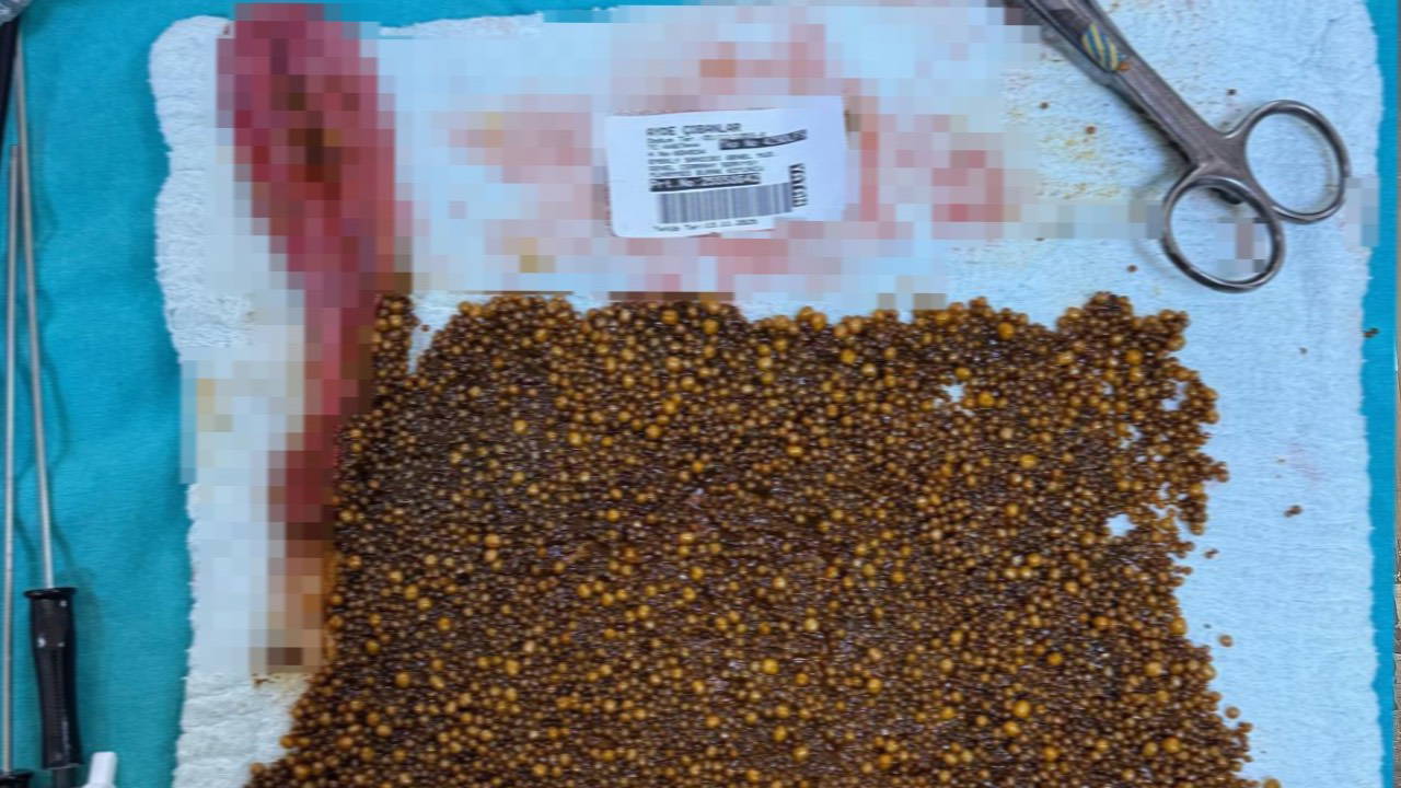 Hastadan çıkan taşları sayamadılar: 20 binin üzerinde 