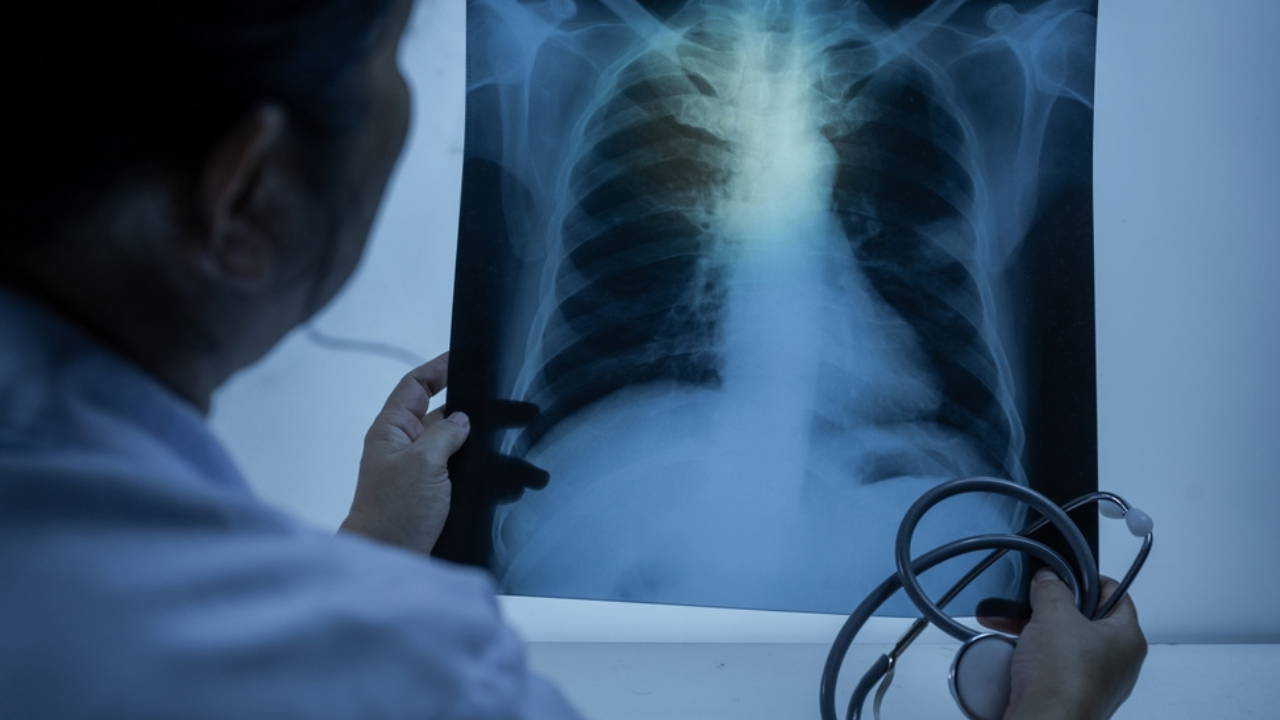 Uzmandan 'zatürre' uyarısı: ‘Akciğer kanserinin habercisi olabilir’