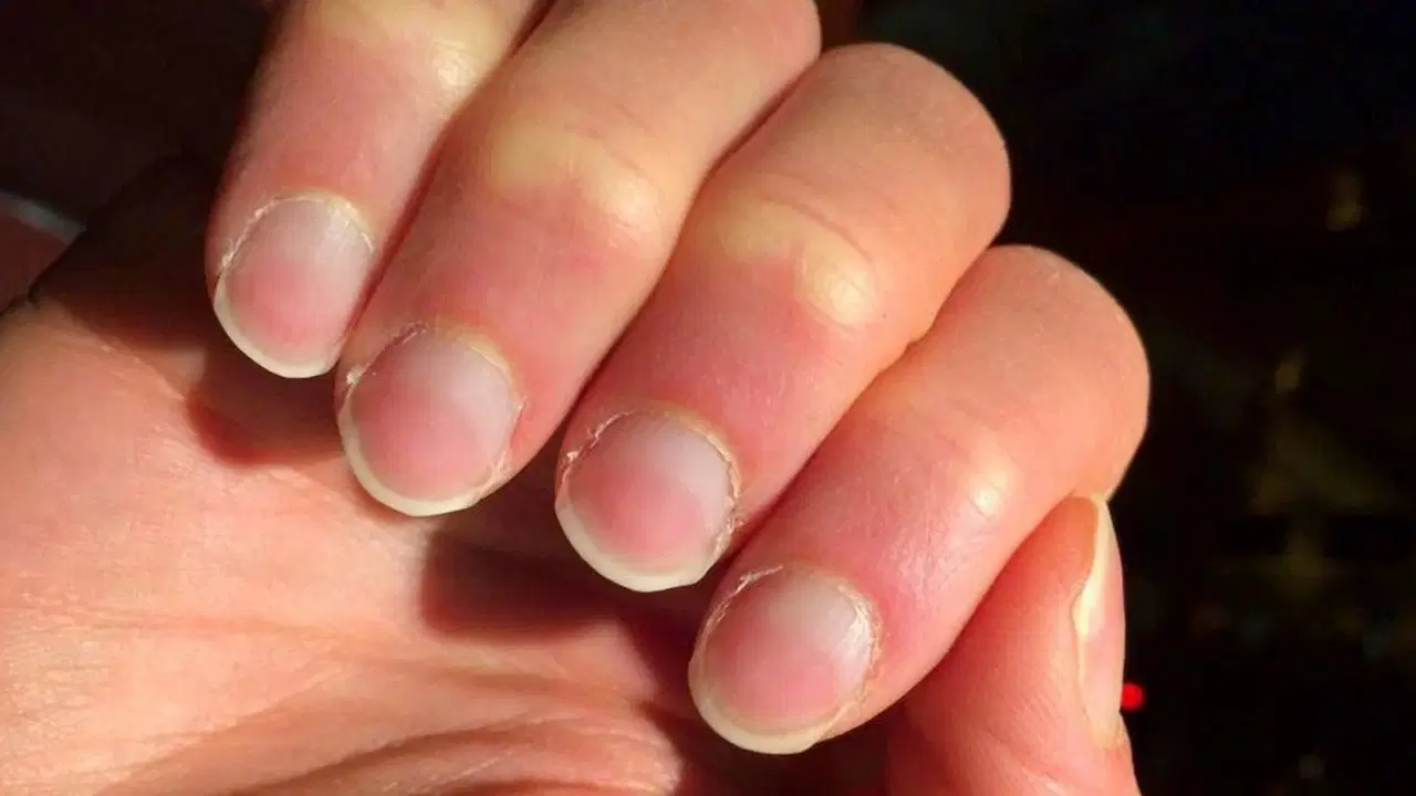 Tırnaklardaki sessiz uyarı: Hangi değişim hangi hastalığın habercisi?