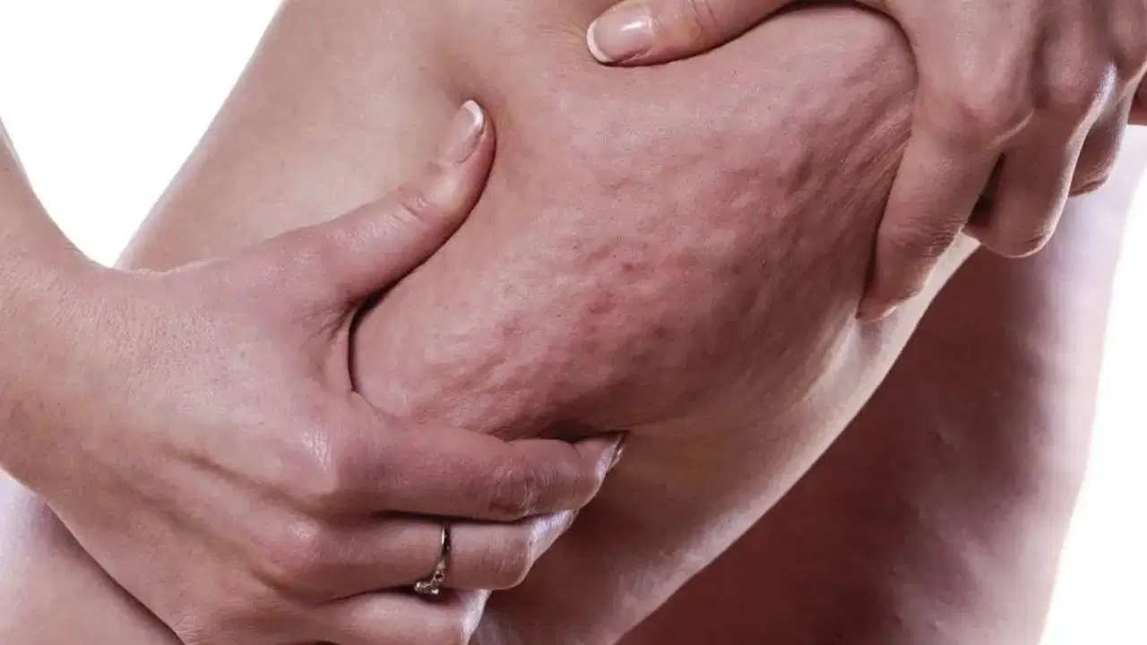 Kadınların sessiz çığlığı: Lipödem