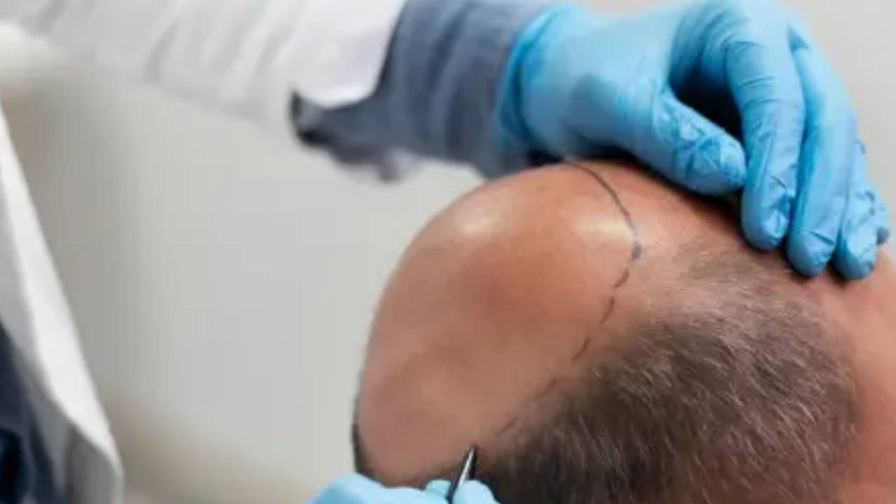 Saç ekimi birimleri hakkında yönetmelik değişikliği Resmi Gazete'de