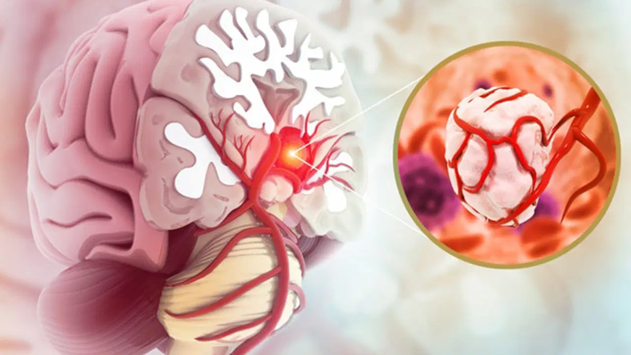 Bu işaretlere dikkat: Beyin tümörünün habercisi olabilir!