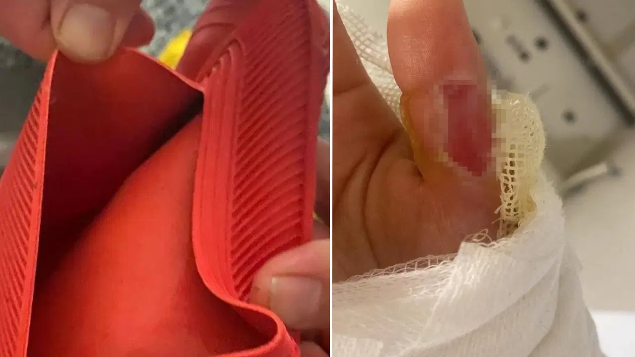 Sıcak su torbası patladı, genç kızın vücudunun yüzde 25’i yandı