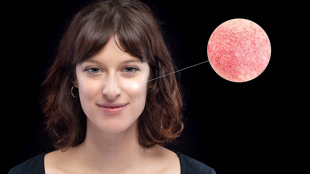 Yüzdeki kızarıklık ve yanmaya dikkat! Gül hastalığının habercisi olabilir