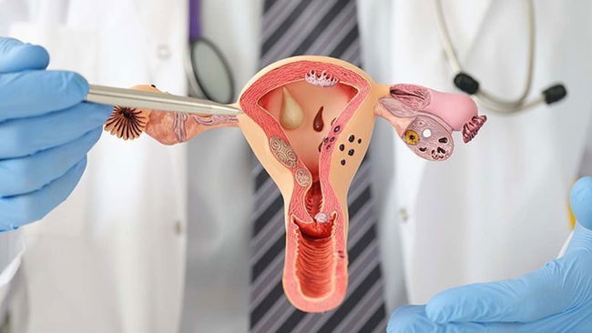 Karın şişliği ve erken doyma yumurtalık kanserinin belirtisi olabilir