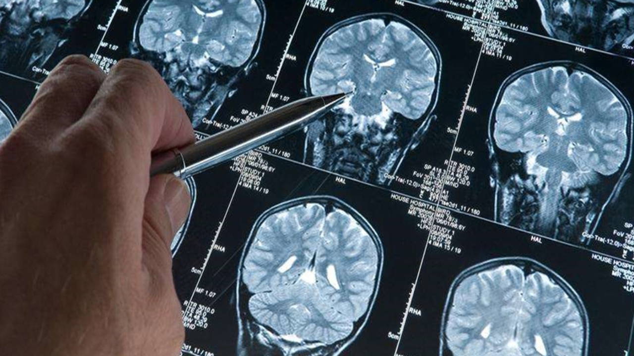 Erken teşhiste yeni adım: Alzheimer’da 'kan testi' dönemi