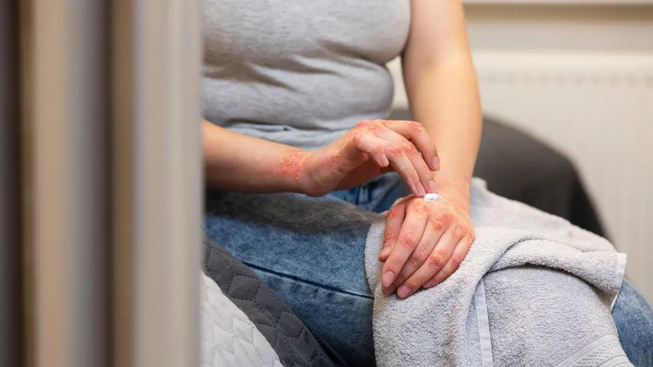 Sıcak su cildin koruyucu bariyerini eritiyor: Kış egzamasının en büyük tetikleyicisi...