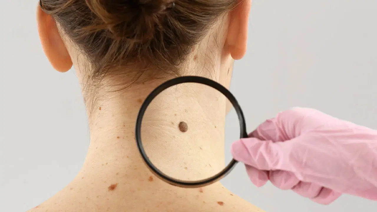 Dermatoloji uzmanı açıkladı: Benlerdeki değişiklikleri hafife almayın!