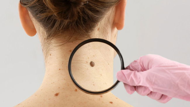 Dermatoloji uzmanı açıkladı: Benlerdeki değişiklikleri hafife almayın!