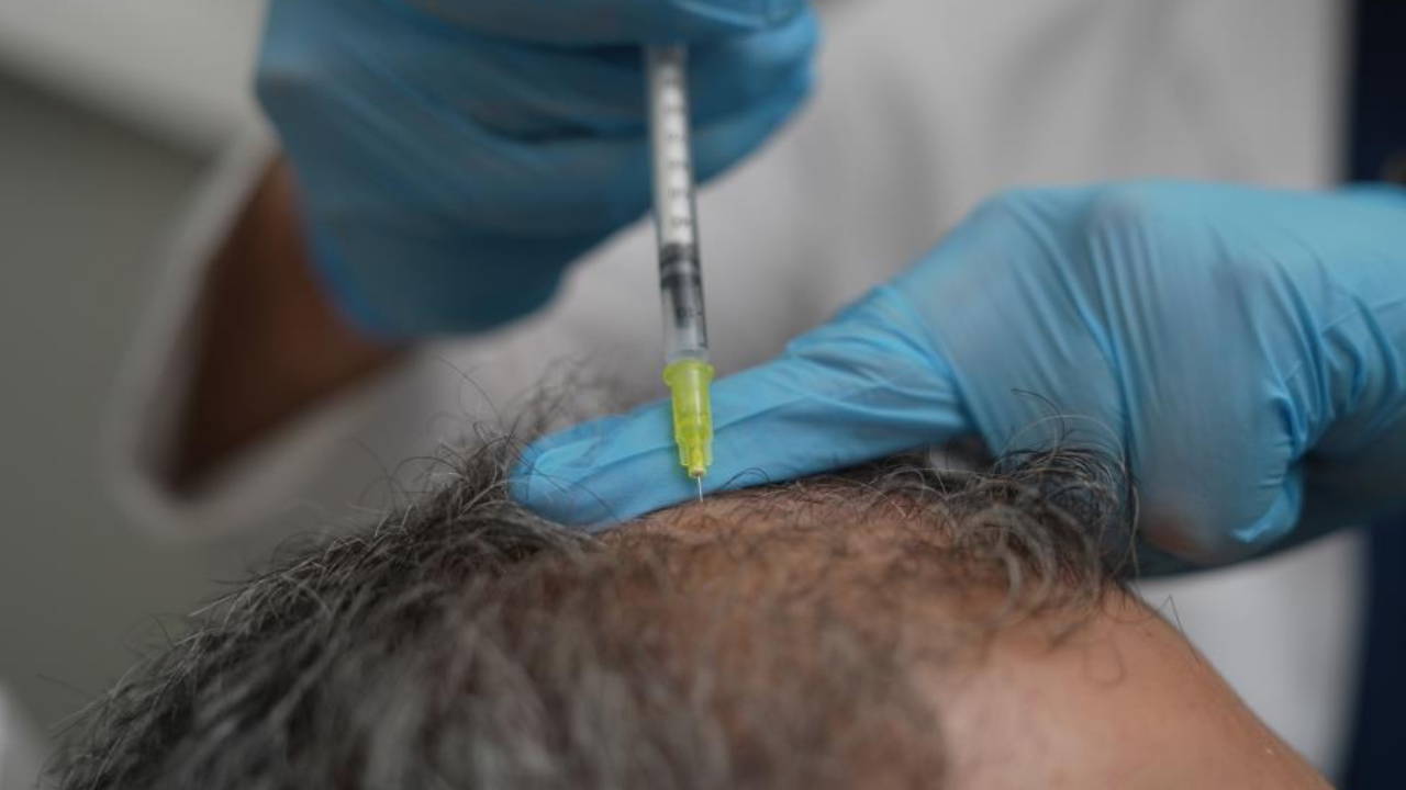 Telogen, saçkıran, erkek tipi dökülme: Saç dökülmesi vücudun bir alarmı olabilir!