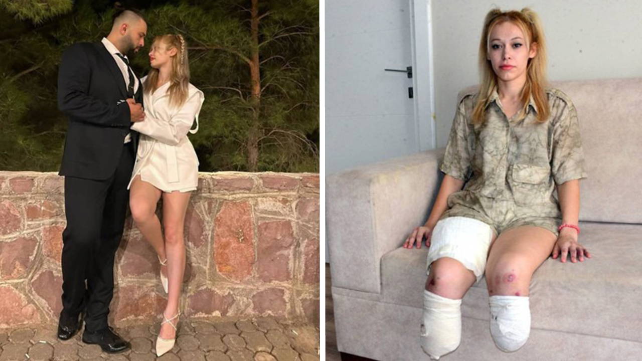 Evlilik yıldönümü faciayla bitti: Genç fitness eğitmeni iki bacağını kaybetti